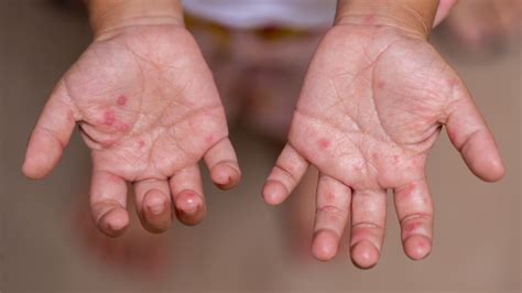 hfm twitter|About Hand, Foot, and Mouth Disease .